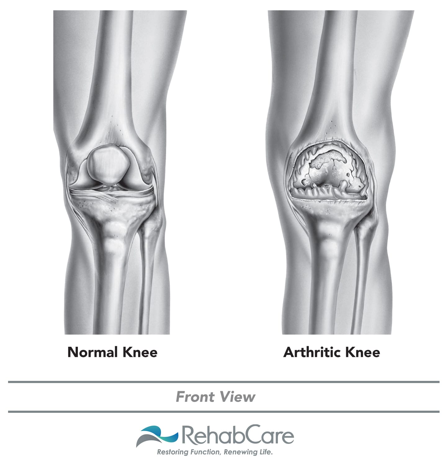 rehabcare knee