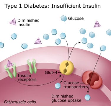 type 1 diabetes glucose metabolism